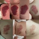 딸기혈관종 치료기록 [5]