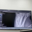 제5중수골 골절 손골절 1-3주차 (핀고정 골절 수술, 수부전문의, 수부전문병원,이대서울병원 골절수술)