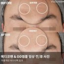 바쿠나 MTS 무통증 메디코펜 (나노니들) 안전한 MTS 추천!!