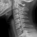 44세 여 l5-s1 large disc herniation 치료, 대처 사례 이미지