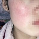 키라에스테틱 | 홍조 없애는법 찾다가 정착한 홍조 디바이스 오로라 더마샷 한달 솔직후기