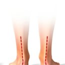 만성 통증 | 발아치 깔창 고르는 법 (만성 발통증 환자 후기)