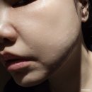 인천서구 성형외과 리쥬란 힐러 2cc 후기 건조하고 얇은 피부 스킨부스터로 쫀쫀하게
