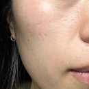 미주메디칼 | 창원 피부과 창원 스킨부스터 미주란 관리 후기 시티세븐한의원 창원 엑소좀 라디쥬