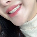 계양플란트인치과의원 | 인천 계양구치과 추천｜치아미백 효과 리얼 후기