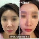 압구정역 성형외과 민트실, 엔픽스 실리프팅 붓기통증 후기