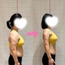 수지척추체형교정
