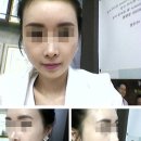 [주먹만한 얼굴 만들기 프로젝트]양악수술+광대+턱+지방이식(이마) - 20 Day 이미지