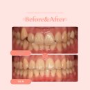 신촌고운미소치과의원 | 신촌 교정치과 송곳니 덧니 투명교정 인비절라인 치료 시 주의사항은?