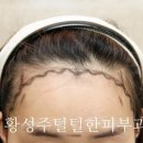 헤어라인 이미지