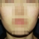 수원안면홍조 발생 원인과 피부과 및 한의원의 치료 방법 비교, 그리고 비용 꼼꼼하게 알아보기