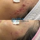 콜드플라즈마 이미지