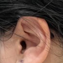 교하제일의원 | 이비인후과/ 가격비교/ 내돈내산 비교/ 수술후기 / 수술후 경과/ 실비청구보상/ 실비정액] + 병원 솔직...