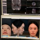 코와이비인후과의원 | 코재수술 잘하는곳 서울 양재 프레쉬이비인후과 수술10일차 내돈내산