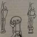 ﻿Rearfoot Varus deformity 이미지