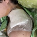 부민약국 - 부산진구 부전로66번길 50 | epidermal inclusion cyst Ex & Bx / Lt.neck Ex & Bx (local) / 표피낭 제거 수술 후기 (L720)