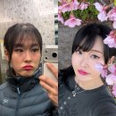 눈 밑 지방재배치, 풀 페이스 지방이식 수술 4개월차 성공 비포애프터 내돈내산 후기