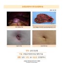 급성담낭염수술후기. 갑자기 소화가 안되고 감기몸살 증세처럼 근육통과 오한과 미열이 있어 종합 감기약과 진통제로... 이미지