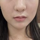 인디언 | 압구정역 피부과 레디어스 팔자 인디언밴드 후기 결절 부작용