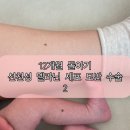 닥터지니성형외과의원 | 12개월 돌아기 선천성 멜라닌 세포 모반 수술 후기_2 (대구 닥터 지니 성형외과)