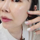 스킨톡스 | 수원시청역 피부과 촉촉한 국산 스킨보톡스 릴리톡스 후기 (+더마톡신 통증, 멍, 전후사진)