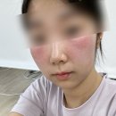 성인여성 얼굴 햇볕화상(일광화상) 10일 후기, 대처법, 주의사항