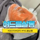 양산피부관리 여드름이 있다면 여드름살롱
