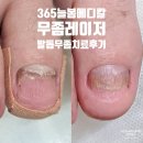 진메디칼의원 | [발톱무좀 한달반] 군포 365늘봄메디칼의원 발톱색깔이 이상해요