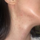 투앤티의원 | 양준상 의원 약먹은지 열흘차 내돈내산 후기 모낭염 비밀의 아이템 공개