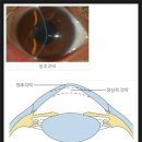 Re: 원추각막원(keratoconus)이란 무엇인가? 이미지