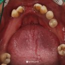 더퍼스트치과의원 음성점 | 음성 치과 에서 소개드리는 전악 임플란트 수술, 수면마취와 라테랄 접근법 적용 사례