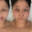 의정부윤곽관리 전후 사진 포함_의정부에스테틱 씨앤제이뷰티 솔직후기