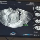 삼신약품 | 인공수정 1차 사이클 과정 및 후기