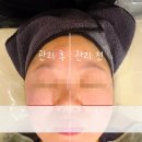 강릉지변동피부샵 썬바디에스테틱 플라모드케어 받은 후기
