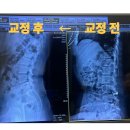 해금 | [아산 천안 탕정] 30대 여성 해금연주자 일자허리 재활과정