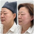 강남역피부과 40대 민트실리프팅 후기