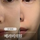 진메디칼의원 | 대구 달서구 월성동 피부과 베러미의원 여름철 속건조 고민 해결 연어주사 스킨부스터 후기