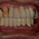 윤치과의원 | [안중 윤치과 공식 블로그] 안중윤치과에서 앞니 임플란트 후기 알려드려요~