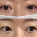 아이컨텍성형외과의원 | 튀어나온 흉터 제거 수술 기록 첫번째 : 함희정성형외과