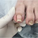 A1171 | 천안내성발톱 아프지 않고 편안했던 오네또 문제성발전문점