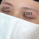 감격의 눈썹문신 붉은잔흔 제거 후기 .. (내돈내산) (흉터/딱지 X)