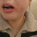 뿌리깊은 이정근치과의원 | 발치의 신 사랑니 명의 선생님 존경합니다 서울이턱사랑니치과 내돈내산 발치후기 발치가격 매복사랑니