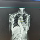 (주)부민교통 | 부민병원 김용정교수님 성인 척추측만증 수술 받은 후기