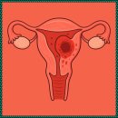 협진농장 | 자궁선근종 수술 후 회복 분당나로한방병원 관리 방법