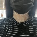지오비뇨기과의원 | 목에 난 쥐젖 제거 후기