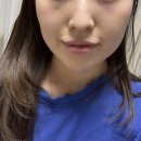 하린약국 | 광주 기미 주근깨 잡티제거 레이저 내돈내산 후기
