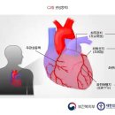 협심증과 급성심근경색 진단비 인정기준의 비교 이미지