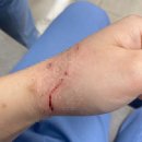 포커스성형외과의원 | 고양이한테 물렸을 때 봉합 병원 추천 : 신중동 포커스 성형외과