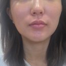 대원한방병원 | 강남 코성형 가상성형 상담 받고 늑연골 코수술 결정한 후기