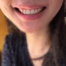 에이스마일치과병원 | 거미스마일 잇몸성형 1달차 리터치 찐리얼후기, 변화과정, 내돈내산 잇몸레이저